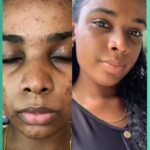 Hyperpigmentation_Results_Using_Perfec-Tone___The_Best_Products_For_Dark_Spots